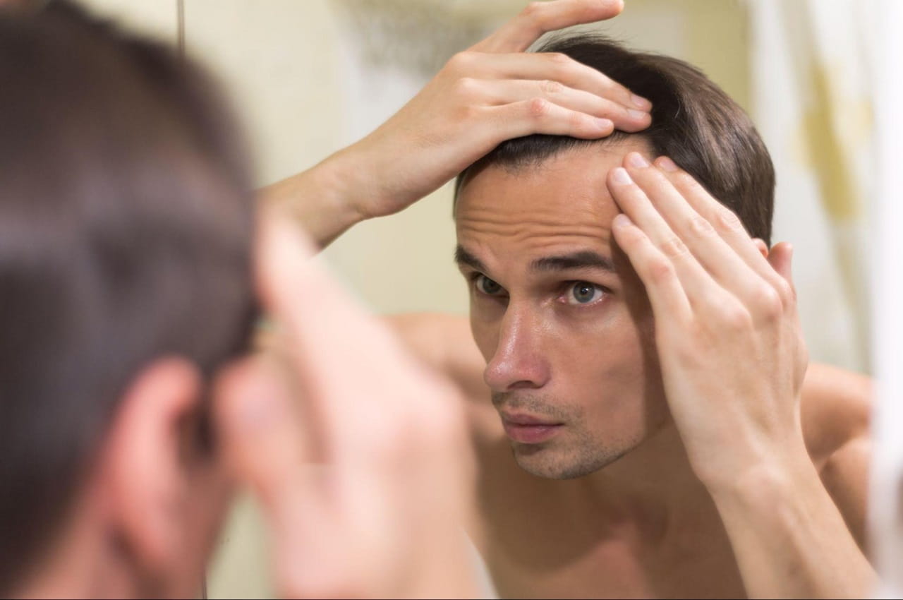 Homem olhando no espelho e tocando a linha do cabelo com uma feição de preocupação com a perda de cabelo. 